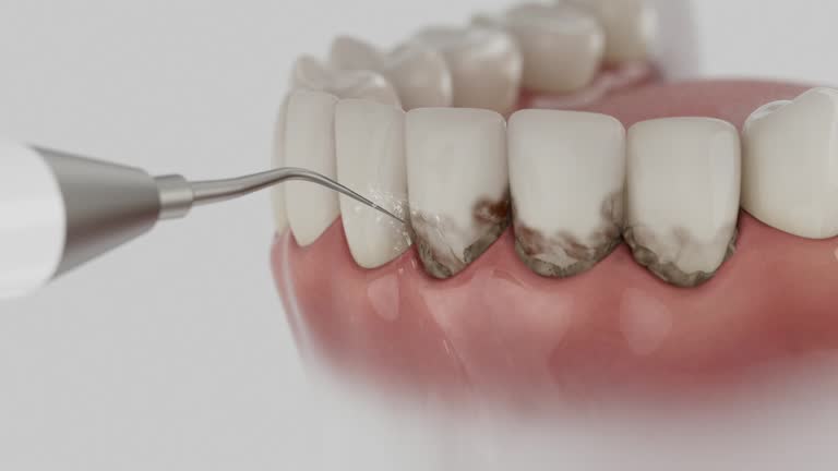 Trusted Wisdom Tooth Removal service in Coal Fork, WV - Dentist Open Now